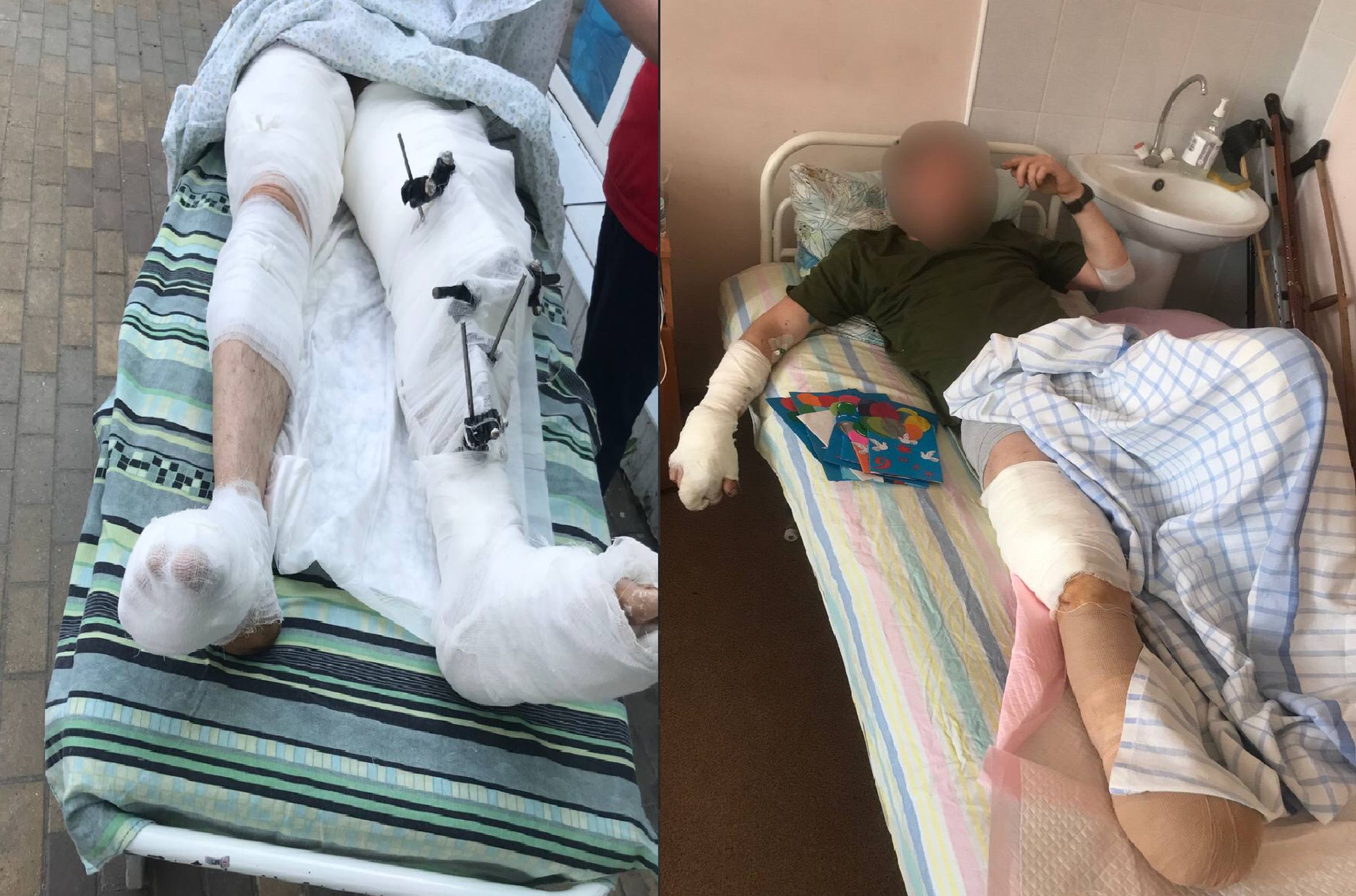 A military serviceman whose limbs were saved by doctors, and a serviceman with an amputated foot